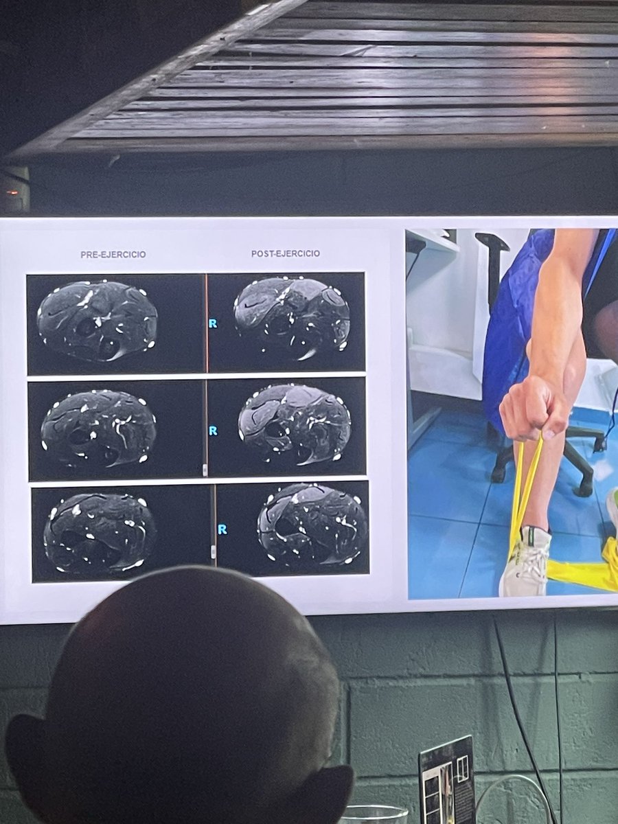 draulrikita's tweet photo. Genial como siempre el @MadridBoneClub previo al verano . Mucha ciencia, muchos amigos y mucha 🍺🍻. Deseando la “vuelta al cole”en septiembre @drwillyjara @AngelHorcajadas @angelesmangela @DrPepeFdez @akassarjian https://t.co/lsZM61gXxZ