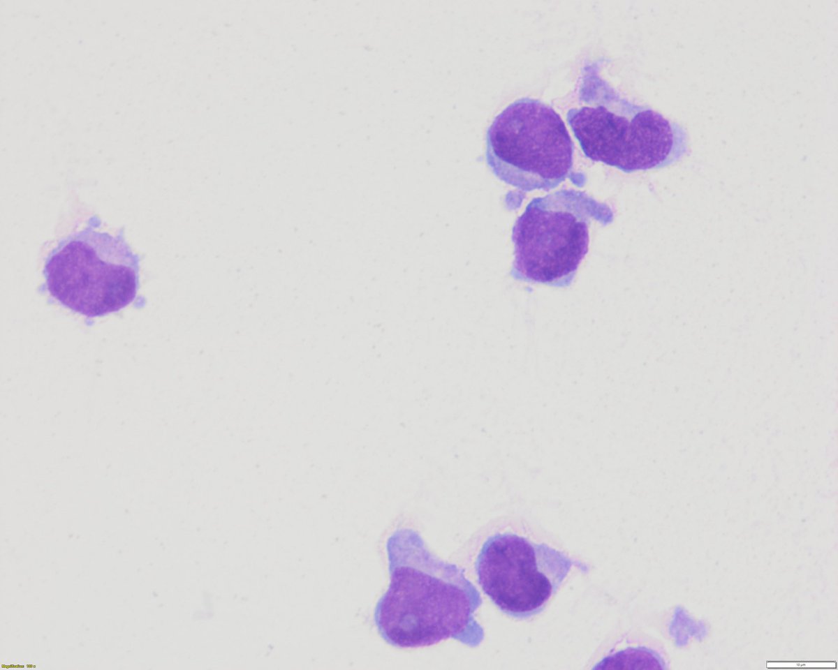 sanamloghavi's tweet image. Post #EHA2023 blues??  
Indulge in this  #hemepath #cytopath quiz. CSF cytospin in a patient with ETP T-ALL…. Left image is baseline (positive)… right is follow up…. Is the single cell a blast or not? Poll below 👇🏻