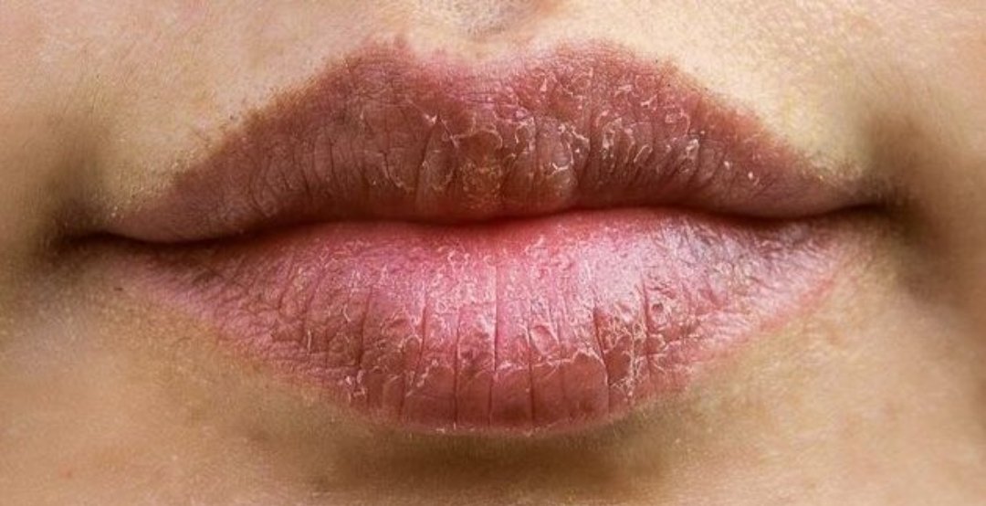 empezó el frio y mis labios están así....
