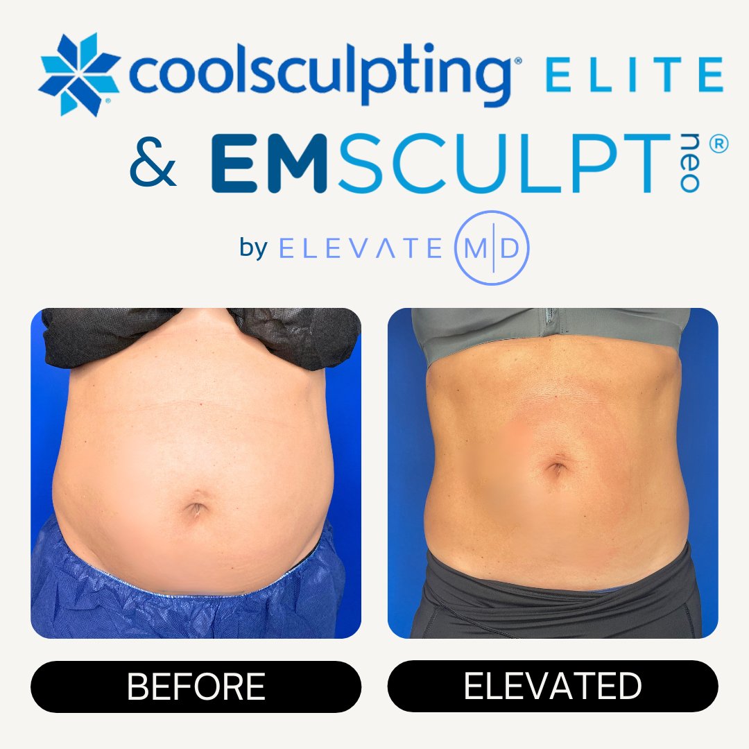 💪✨ EmSculpt Neo sculpts and strengthens your muscles while burning fat, while CoolSculpting Elite freezes away stubborn pockets of fat. The perfect duo to achieve your dream body! 💯🔥❄️ #FireAndIce #BodyTransformation #EmSculptNeo #CoolSculptingElite #DreamBody #SculptAndTone