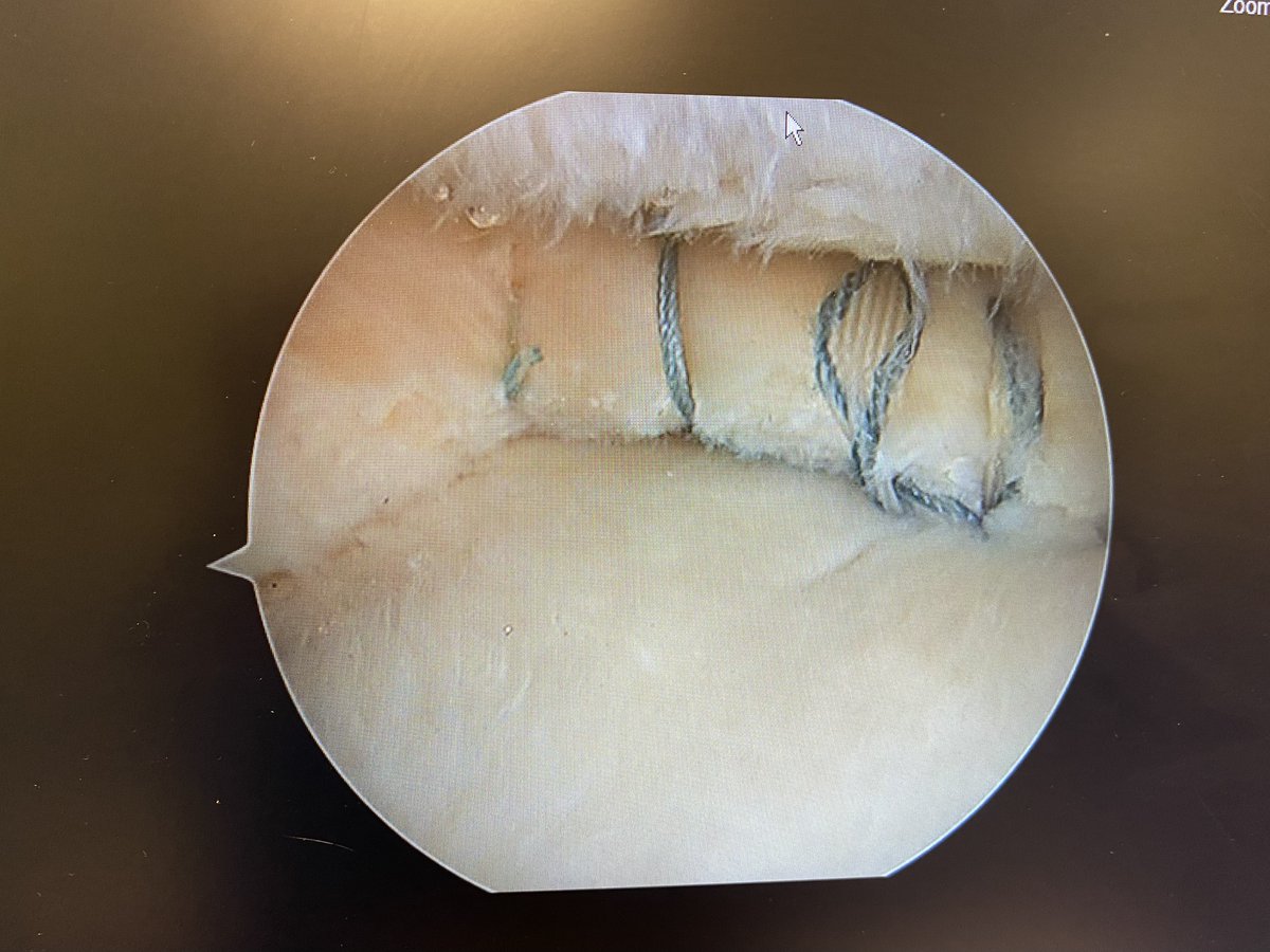 DrNickColyvas's tweet photo. #rootrepair plus
often the meniscus itself is somewhat worn out, and some needs repair in addition to the root refixation.
#orthotwitter https://t.co/y9t0CG4SuB