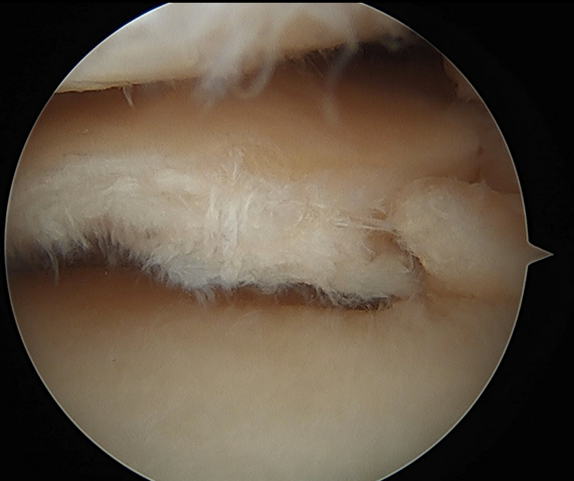 DrNickColyvas's tweet photo. #rootrepair plus
often the meniscus itself is somewhat worn out, and some needs repair in addition to the root refixation.
#orthotwitter https://t.co/y9t0CG4SuB