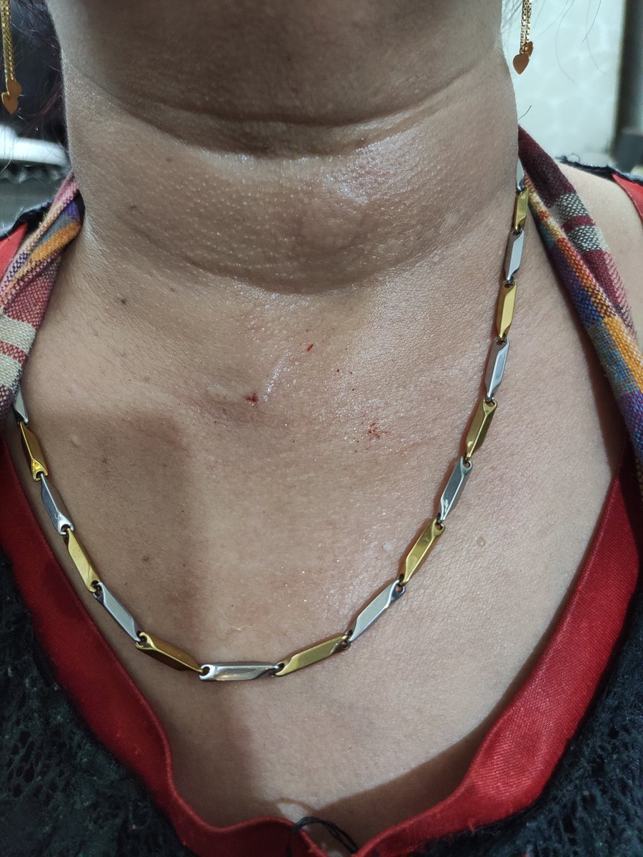 TejasviVerma7's tweet photo. Yesterday night when my mom was using Inalsa Amaze Mixer the blades flew out of the so called sturdy jar from the side &amp; hit her neck,she could have died. Who is responsible for safety &amp; compensation @INALSA_OFFICAL @jagograhakjago @bis_manak @consumerforum_ https://t.co/YGnnVdzTZ9
