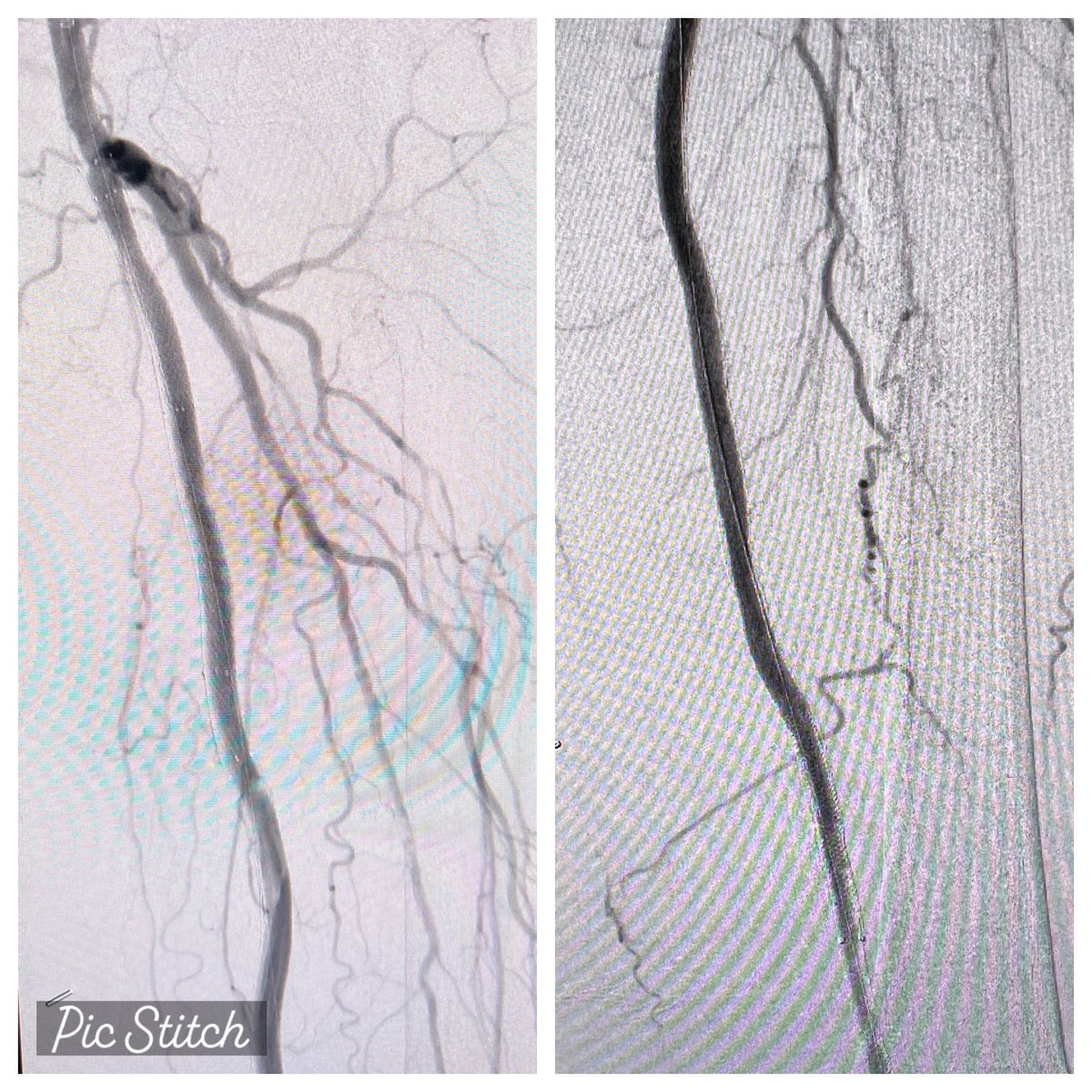 monteromiguel's tweet photo. Long SFA-pop stent in 2019. Stopped DAPT 2 months ago which lead to severe rest pain. Found occluded stents from ostial SFA down to Pop2. No conduit. High periop cardiac risk. Cleared with #Rotarex 6F x2 passes. What’s your tool of choice for this sort of in-stent occlusion? https://t.co/sGY3hIiEVn