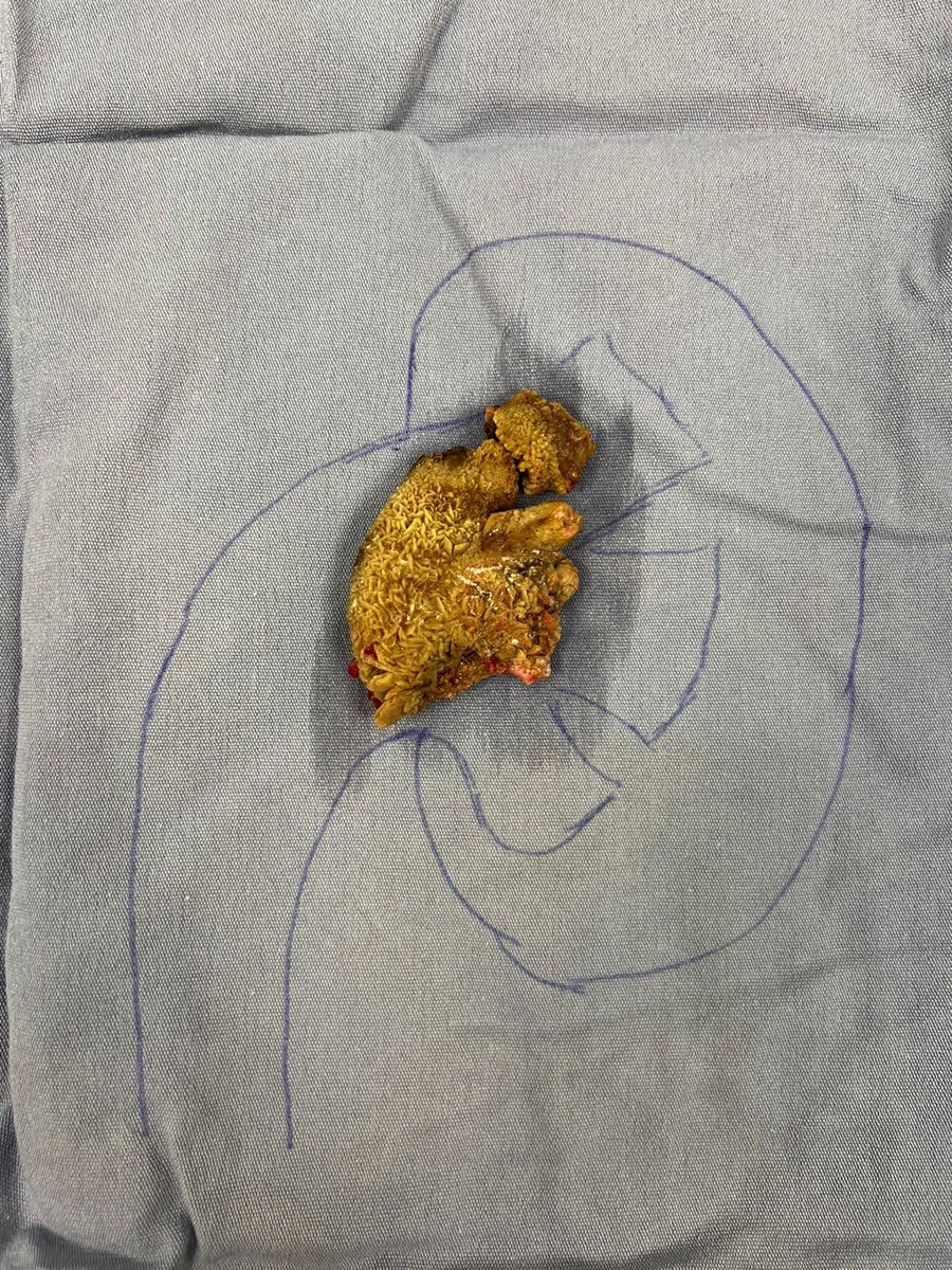 uro_chris_udm's tweet photo. Today… a laparoscopic anatrophic #nephrolithotomy. Ischemia 20 min, bleeding 200 cc. 
Please share your thoughts
@Puebla 
@MarioMeog 
#UrologosdeMexico https://t.co/q995I0KFQl