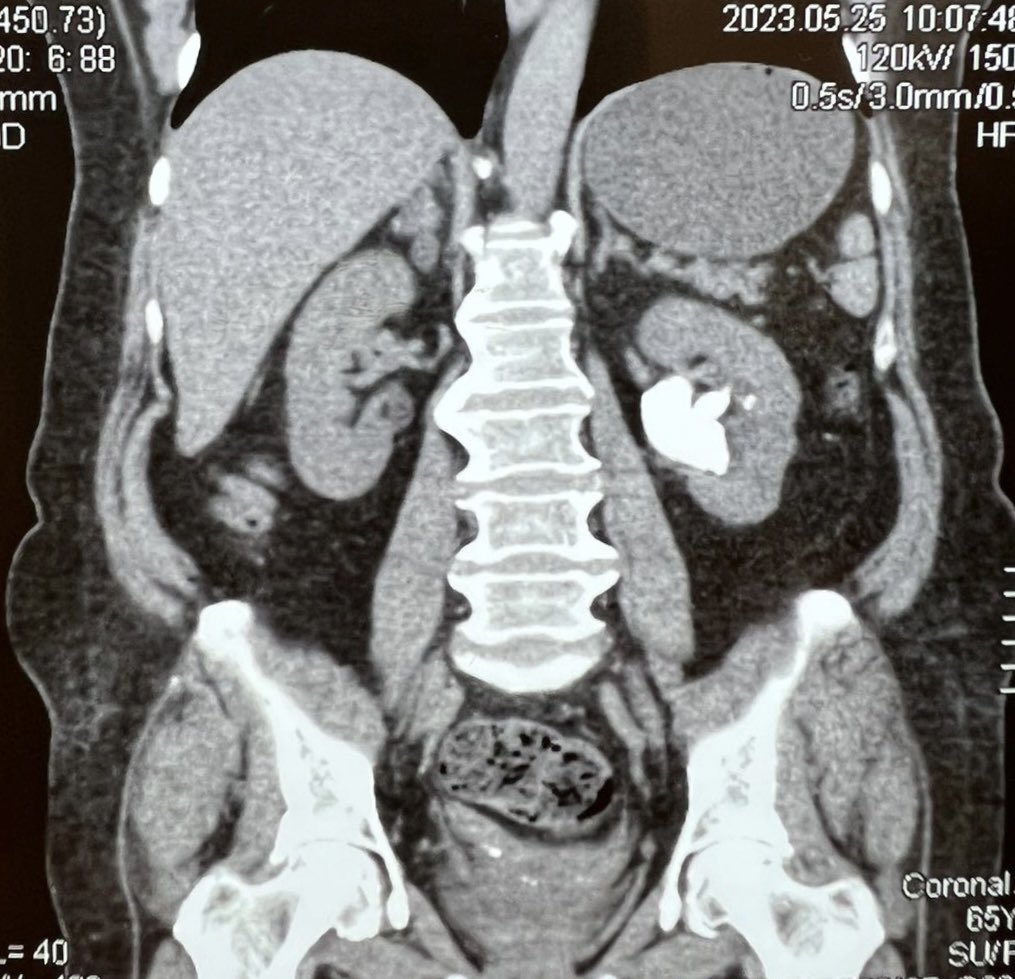 uro_chris_udm's tweet photo. Today… a laparoscopic anatrophic #nephrolithotomy. Ischemia 20 min, bleeding 200 cc. 
Please share your thoughts
@Puebla 
@MarioMeog 
#UrologosdeMexico https://t.co/q995I0KFQl