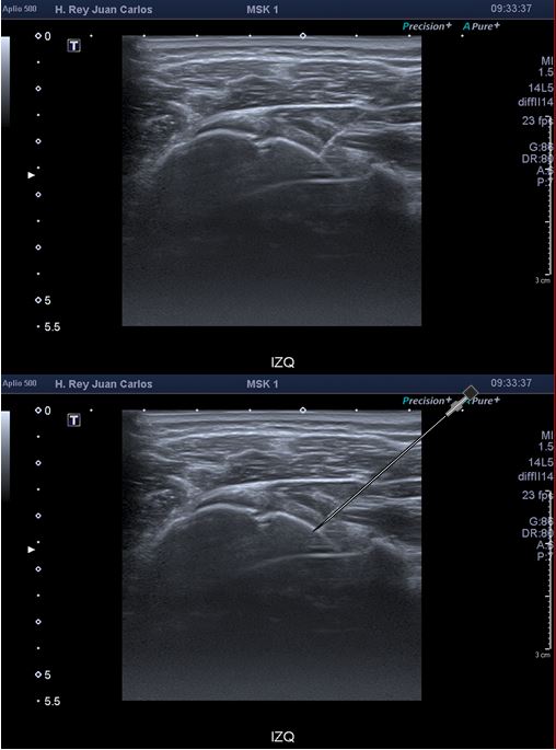 Continuing from the previous tweet on glenohumeral joint MR-arthrogram, here are some images showcasing my preferred puncture technique. Using a posterior approach under ultrasound guidance, I insert a 22G spinal needle in the posterior recess, arm externally rotated. #MSKRad