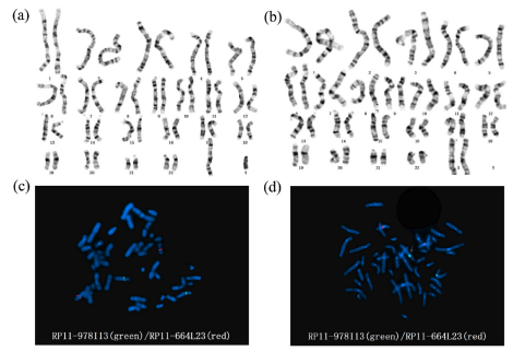 GynecologyGOCM's tweet image. Cytogenetic analysis is becoming essential for diagnostic information and genetic counseling. Two cases with chromosome 6 microduplication and chromosome 9 microdeletion show different clinical manifestations. 
#genetics
#chromosomalabnormalities

bit.ly/42M5Wjw