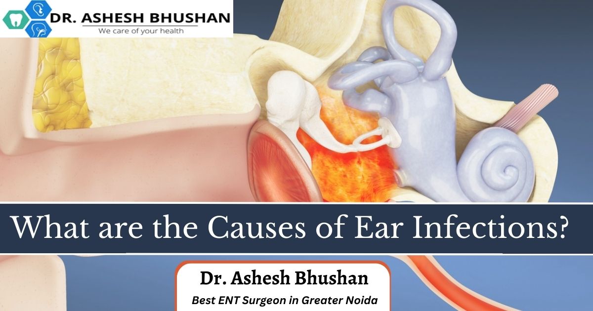 What are the causes of Ear Infections?
-
To know more, Read our Blog 📷
****
Consult With Dr. Ashesh Bhushan
.
📷 Read our Blog: completeentsolution.com/2023/02/14/wha…
****
#drasheshbhushan #helathytips #sorethroat #flu #cough #health #cold #immunesystem #earache #sorethroatremedy