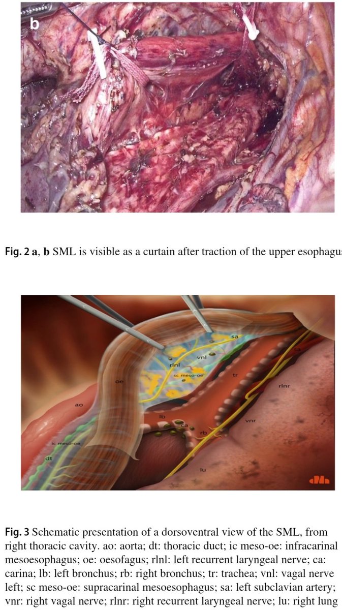 The supracarinal mesoesophagus: a novel anatomical description, by Prof. M.A. Cuesta. Just published on Surgical Endoscopy (open access)👇
link.springer.com/article/10.100…