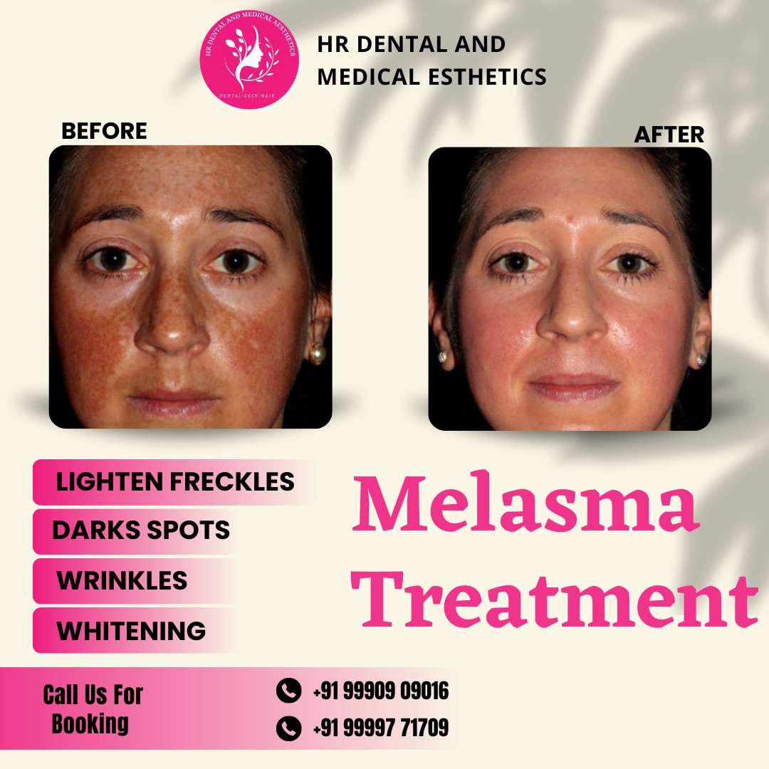 Discover the Power of Radiant Skin with Melasma Treatment at HR Dental And Medical Aesthetics.  
For bookings, call Dr. Himani Bhardwaj at +91 99997 71709 or visit our clinic at SB 34, Shashtri Nagar, Ghaziabad. 
#HRDentalAndMedicalAesthetics #hrdentalcare #MelasmaTreatment #skin