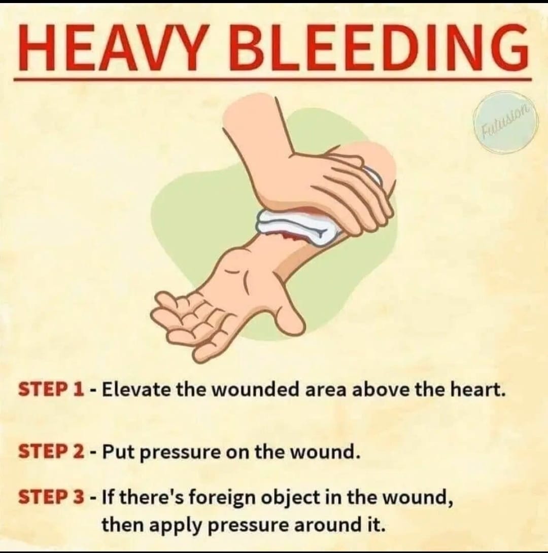 FIRST AID TREATMENTS YOU SHOULD KNOW TO SAVE LIVES

{THREAD}

HEAVY BLEEDING