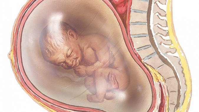 Did you know? 

Polyhydramnios is a condition where there is excess amniotic fluid of more than 1500ml or an amniotic fluid index >25 centiles. 

Causes:
-Maternal diabetes 
-fetal anemia
-monozygotic twin
-feto-fetal transfusion. 
-Malformations such as in  Omphalocele.