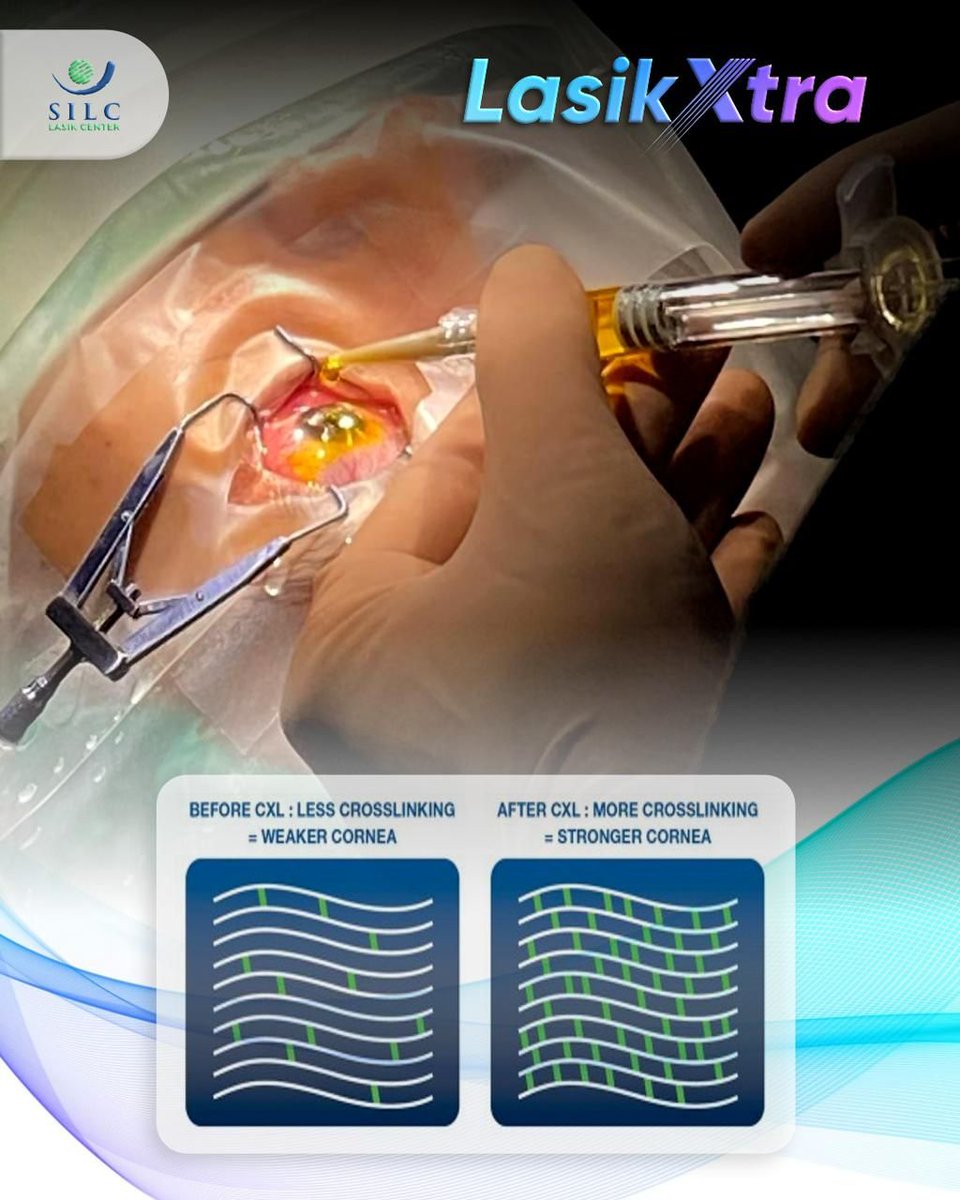 Lasik Xtra

In This Picture
Before CXL : Less Croslinking = Weaker Cornea
After CXL : More Crosslinking = Stronger Cornea

#LASIK #lasikmata #LasikLaser #LasikLaser #lasikcenter #lasiksurgeon #internationalconference #roadbike #roadtrip #roadrace #Bicycle #sepedalipat