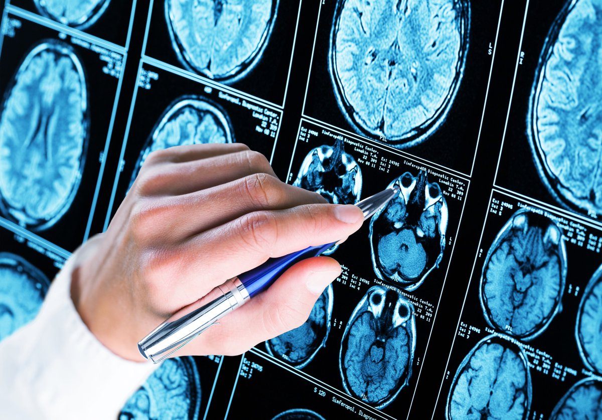 #UQ's Associate Professor Karin Borges and her team are identifying the role Medium chain triglycerides (MCTs) have in the treatment for #Epilepsy 

Read more 🔗 medicine.uq.edu.au/blog/2023/06/a…