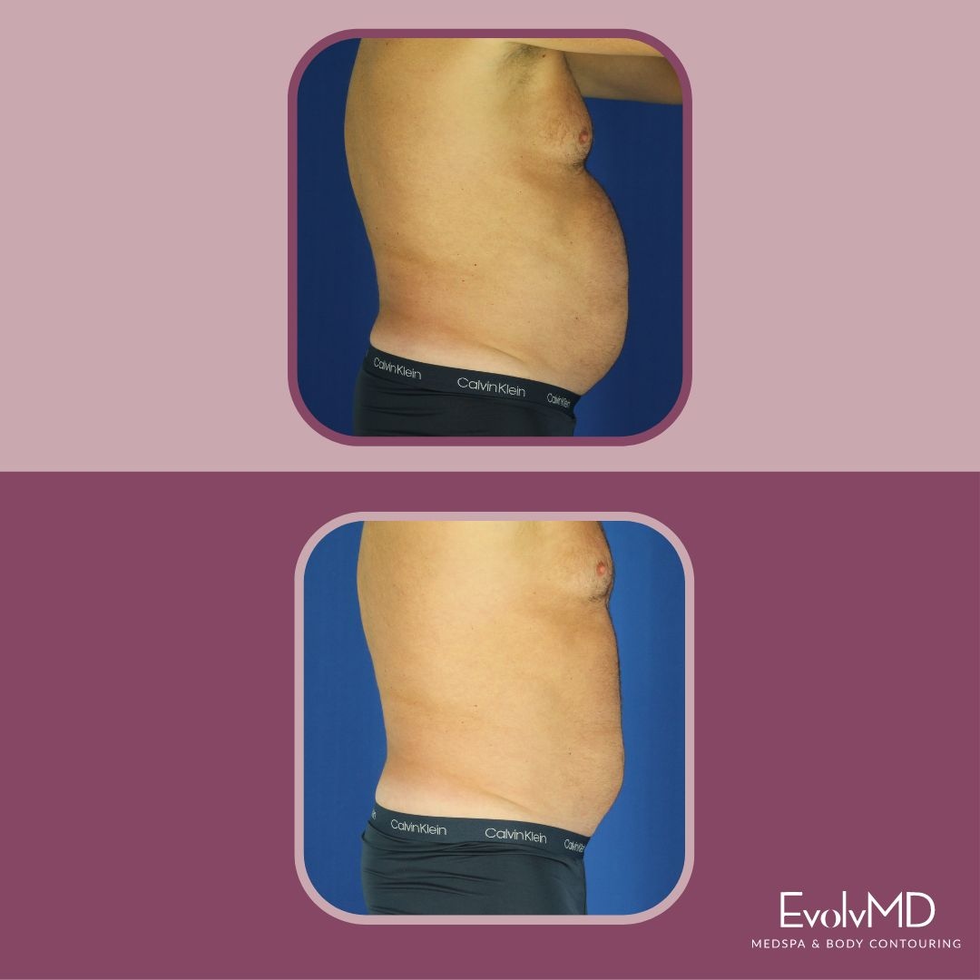 30 Minutes from the Body of Your Dreams!😉 EmSculpt Neo is a 30-minute painless treatment that burns fat & tones. This month, book your Emsculpt Neo package with a friend and save 45%. #milwaukee #bodycontouring #emsculptneo #mke #skin #spa l8r.it/z86x