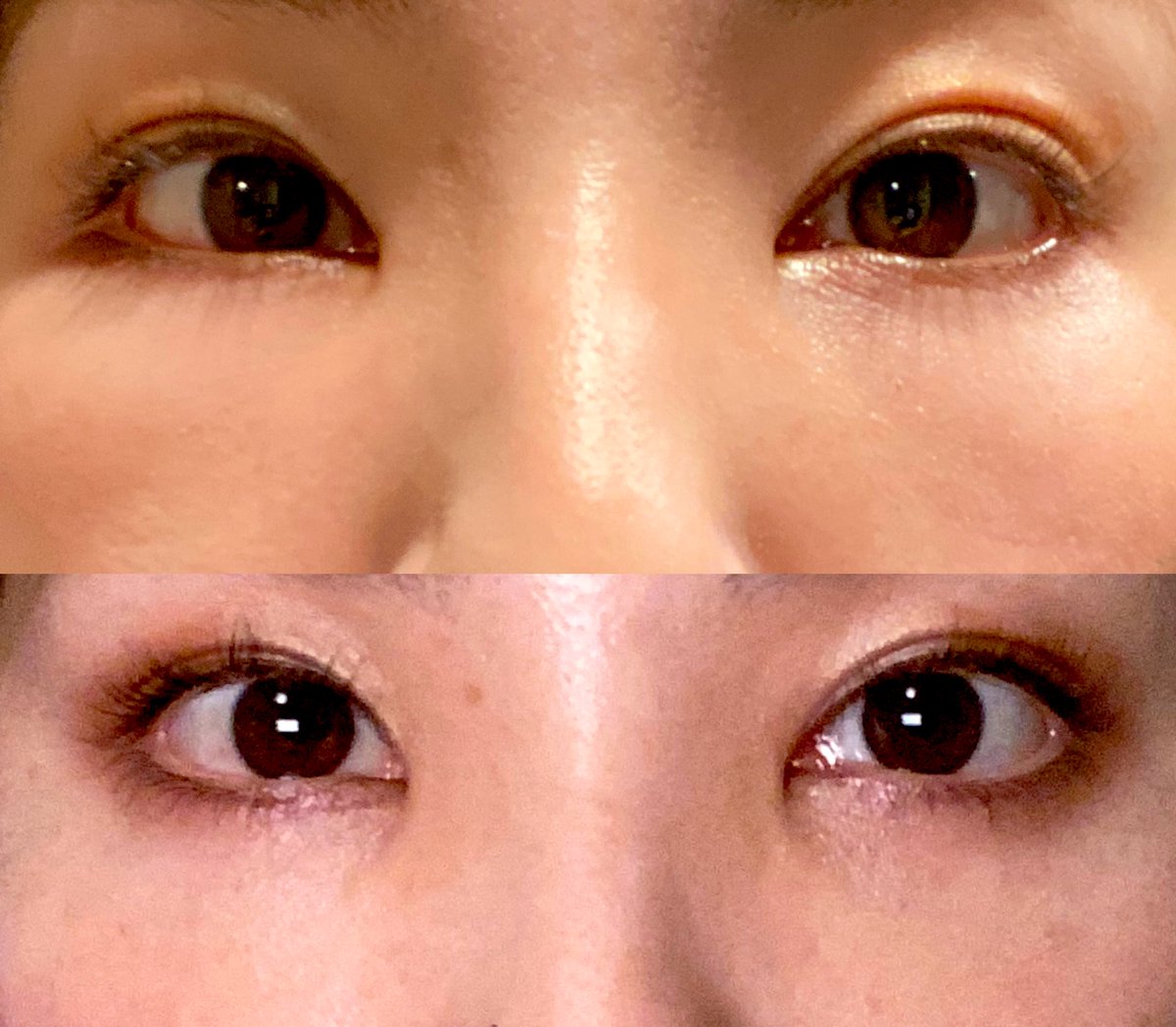 arisamanian's tweet photo. DT4日目

上　3日目
下　4日目

朝起きた時両目目頭に少しだけ目やにが出てました。
目の下のズーンと重たい感覚が若干軽減しました！山場は超えたかなと思います。少しマリモッコリのような目から卒業しつつあります👀
どちらもメイクしてます。 https://t.co/x26RhaXl3B