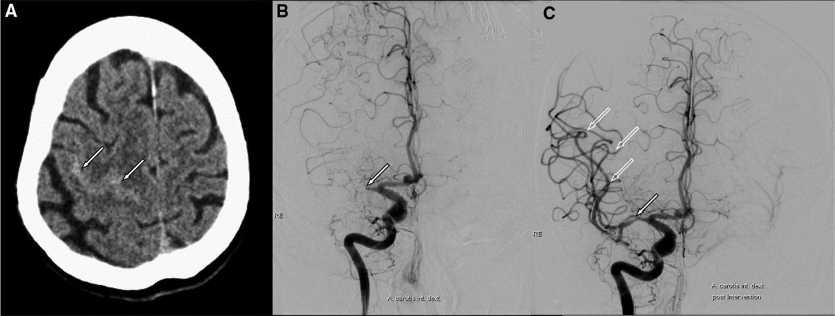 Stroke AHA/ASA on Twitter: "Stroke Images: Convexal subarachnoid ...