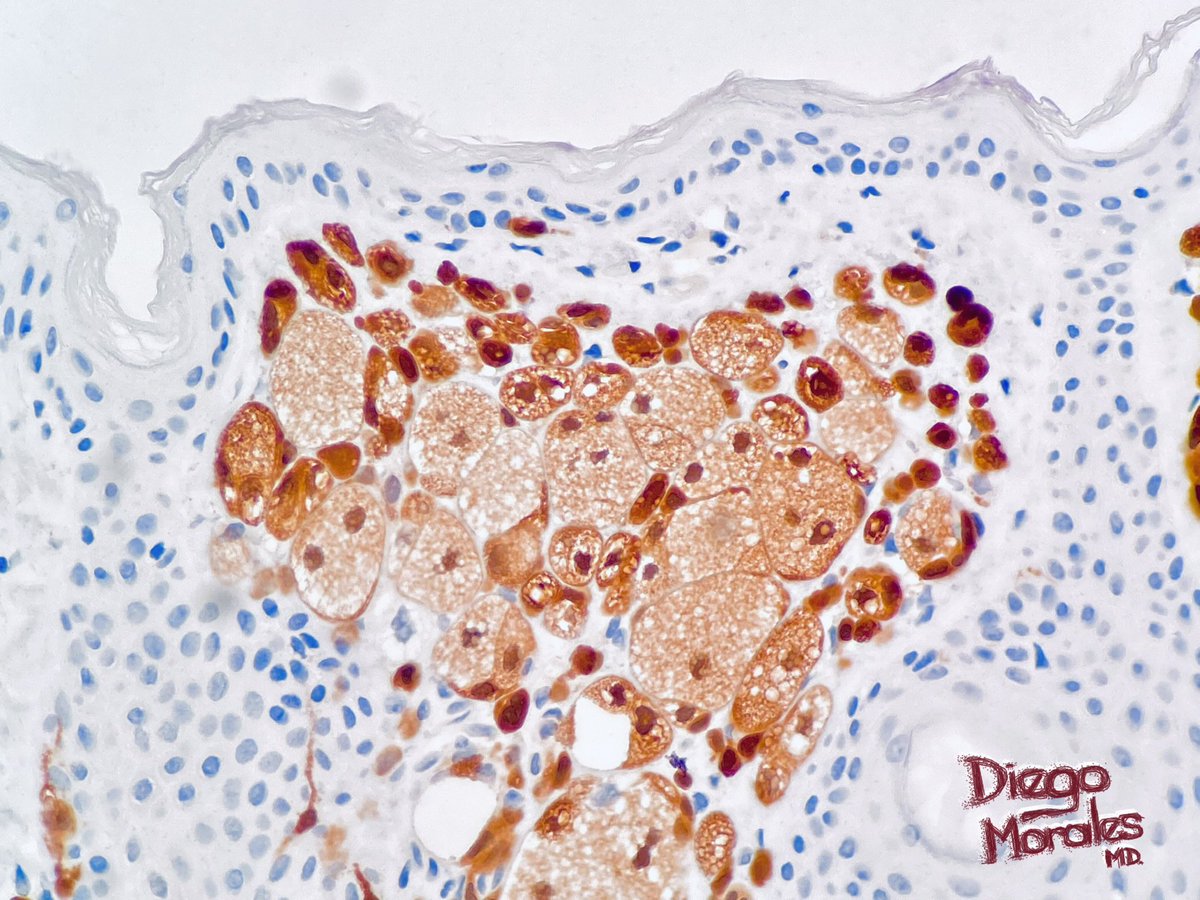Is this #TooCloseToDiagnose ? What is the #ihc stain?

Double challenge for #PathTwitter peeps. #ihcpath #dermpath