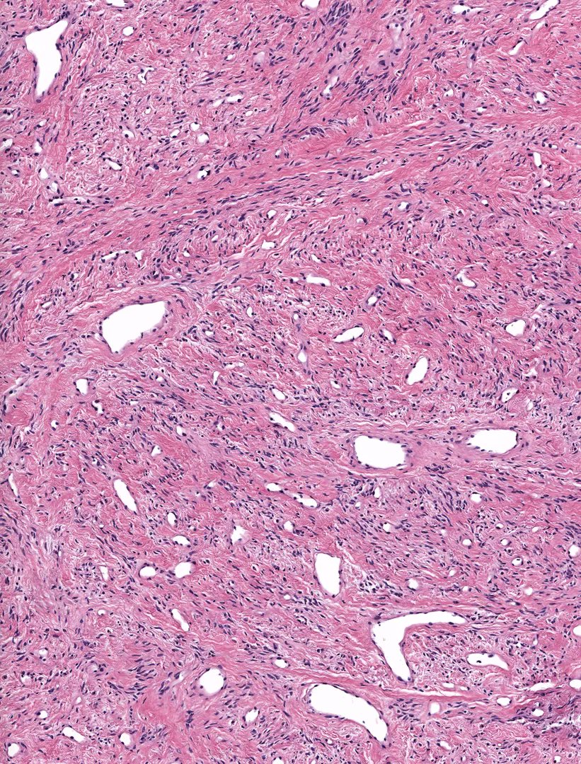 50 yo man with 2 cm inguinal mass. Your diagnosis?
(hint: not all that has staghorn vessels is SFT!)
WSI digital slide: kikoxp.com/posts/4599. 
Answer & video: kikoxp.com/posts/9331
#pathology #BSTpath #pathologists #pathTwitter #gynpath #dermpath