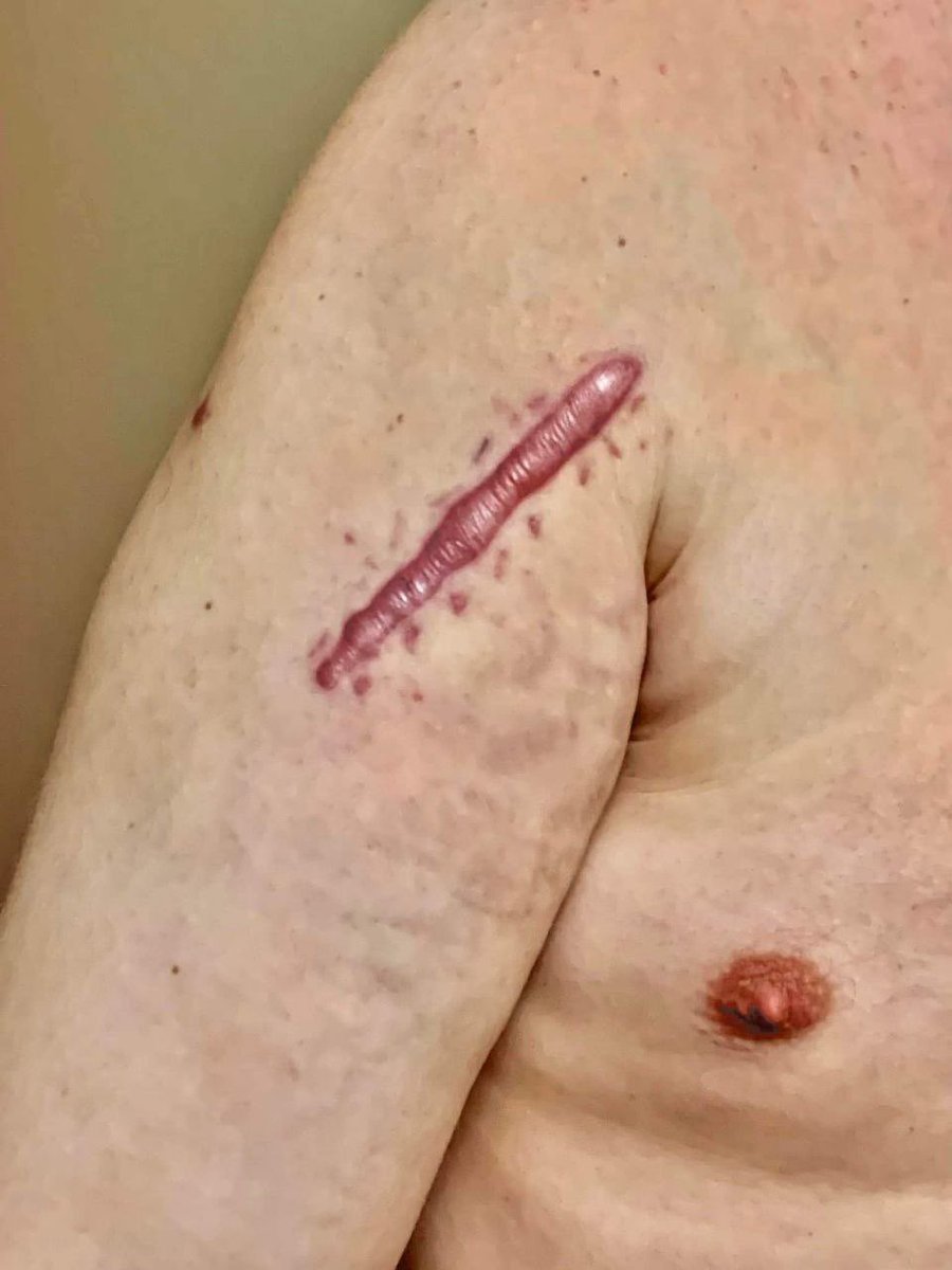 BIZARRE: A fully vaccinated man took to Facebook in May to show his reaction to the Covid Vaccine. 

He had multiple surgeries before taking the vaccine, which had left normal scarring. 

After receiving the Covid vaccine, his scars started swelling, expanding, became discolored,