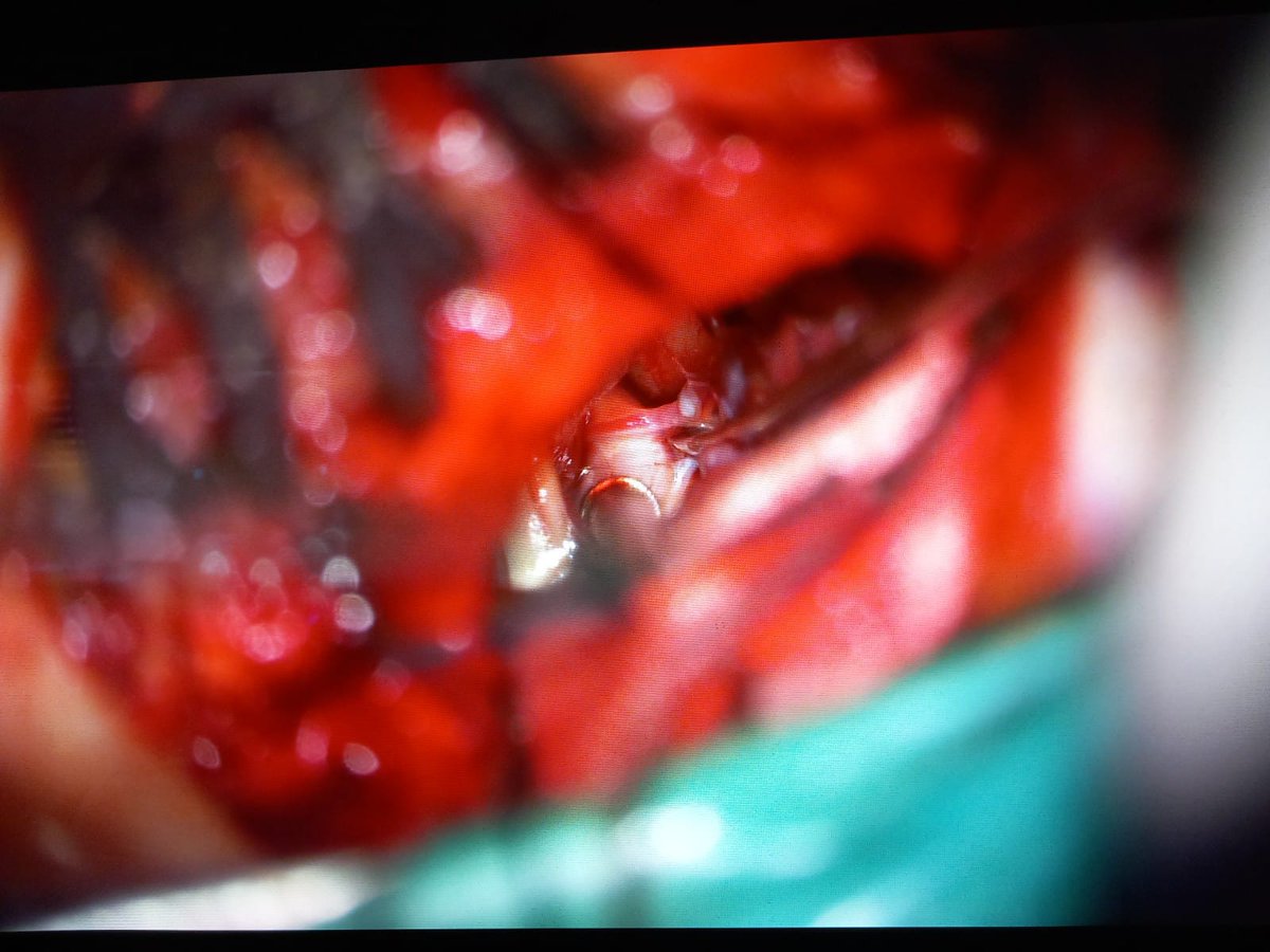 jocabreramontes's tweet image. Pocas cirugías hay tan bonitas y anatómicas como la cirugía de ángulo.

Imágenes de descompresión microvascular del trigémino de hoy. 🤩🧠 #Jannetta #NeuralgiadelTrigémino #Neurosurgery