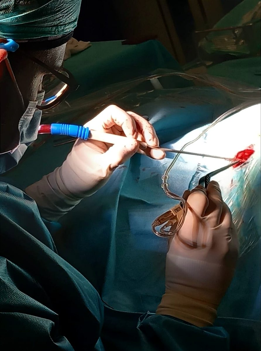 jocabreramontes's tweet image. Pocas cirugías hay tan bonitas y anatómicas como la cirugía de ángulo.

Imágenes de descompresión microvascular del trigémino de hoy. 🤩🧠 #Jannetta #NeuralgiadelTrigémino #Neurosurgery