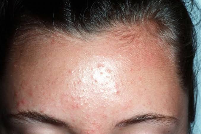 urfairy__'s tweet photo. Gimana sih caranya sembuh dari fungal acne?

🦋 A thread 🦋

Cr pict: google https://t.co/Miz5Om0RaN
