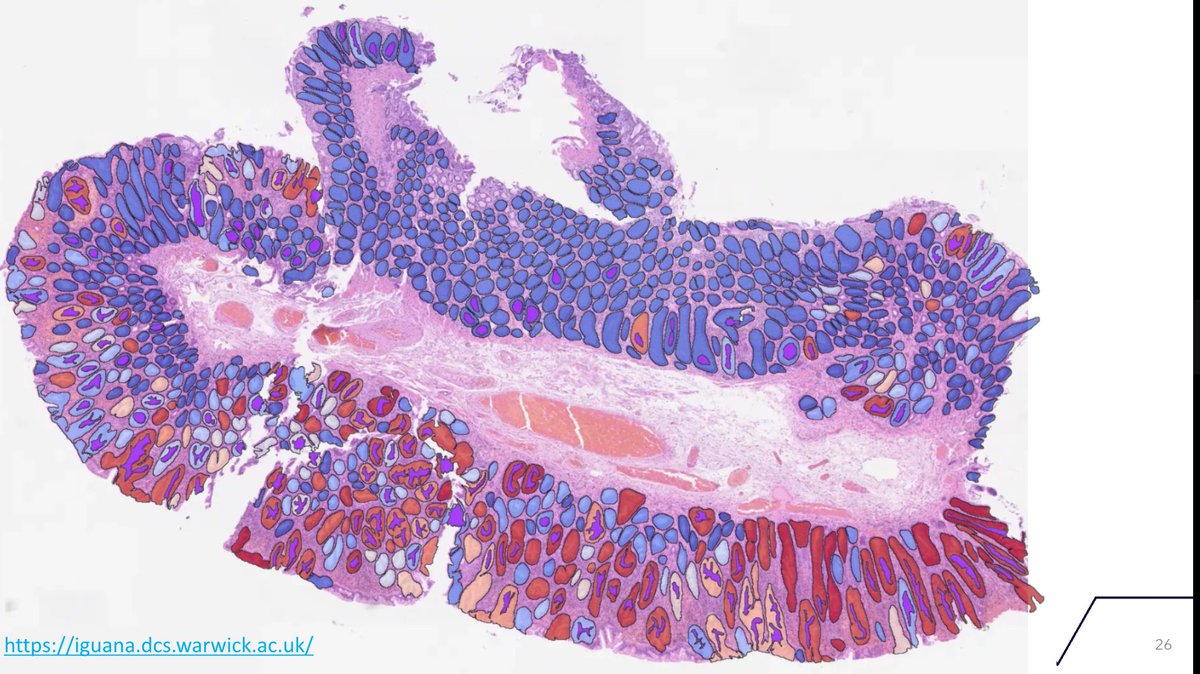 fayyazhere's tweet image. Pleased to present our Gut paper on colorectal screening as a case study on AI in computational pathology at the Digital Pathology Training Symposium at #cpath. Thanks to Prof Gareth Bryson and all organizers for putting together an enjoyable and stimulating session.
