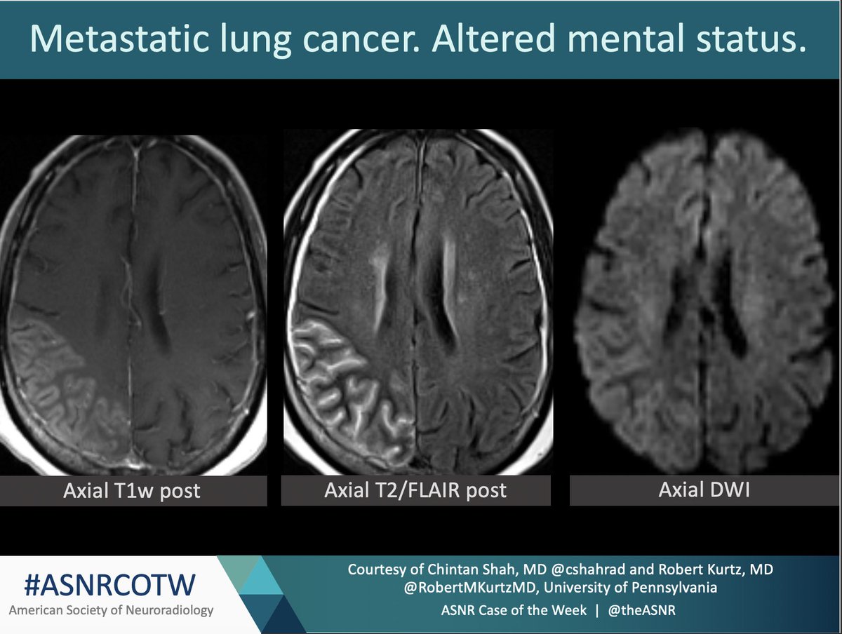 ASNR COTW #151 Hx: Metastatic lung cancer. Altered Mental Status NO SPOILERS!! Give hints in the form of GIFs or answer the attached poll. Answer in 24 hours. #Neuro #Neurorad #radres #FOAMed #FOAMrad #medtwitter #ASNRCOTW @robertMKurtzMD @cshahrad