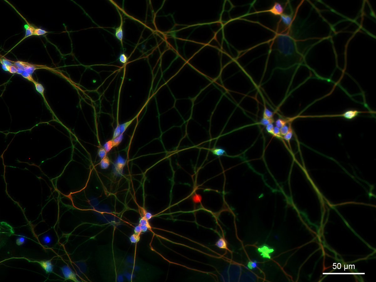 New paper showcasing work from the PhDs of <a href="/NedaAliMohamma/">Neda Ali Mohammadi</a> and myself with <a href="/RJYanezMunoz/">Rafael J. Yáñez-Muñoz</a> and a collaboration with @BowermanNMD <a href="/HeidiRFuller/">Heidi Fuller</a> <a href="/Scattyowen/">Sharon Owen</a>

Read all about our novel SMN1 transgene, motor neurons and lentiviral #genetherapy for #SMA here: rdcu.be/dezQ6