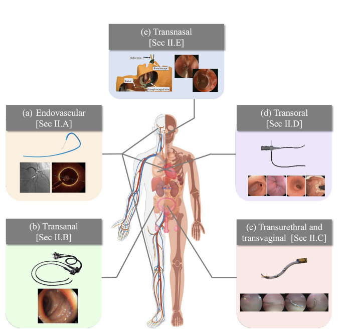 A recent T-RO survey paper highlights the increasing demand for autonomous navigation techniques in #intraluminalprocedures and #endovascularinterventions to reach target areas through body lumens and vessels: ieeexplore.ieee.org/stamp/stamp.js… 
<a href="/AtlasItn/">ATLAS-ITN</a> #medicalrobotics