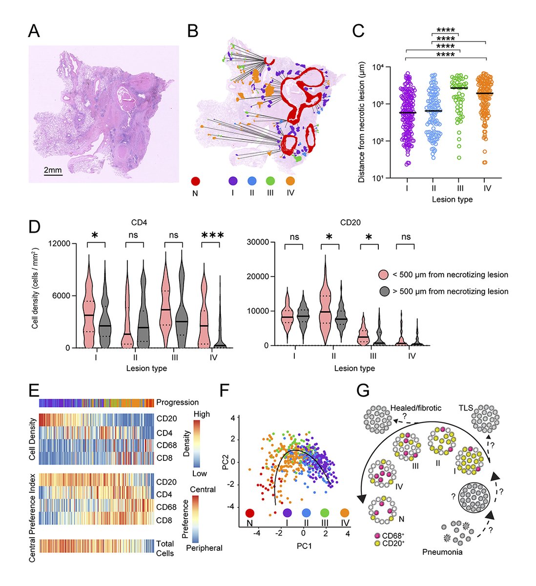 Spatial mapping reveals granuloma diversity and histopathological superstructure in human #tuberculosis. From <a href="/Andrew46306004/">Andrew</a> <a href="/Fenglab_usyd/">Carl Feng</a> &amp; colleagues: bit.ly/3JEBMbK
Featured in our Clinical #Immunology Collection: bit.ly/3oNf0H9
#FOCIS2023