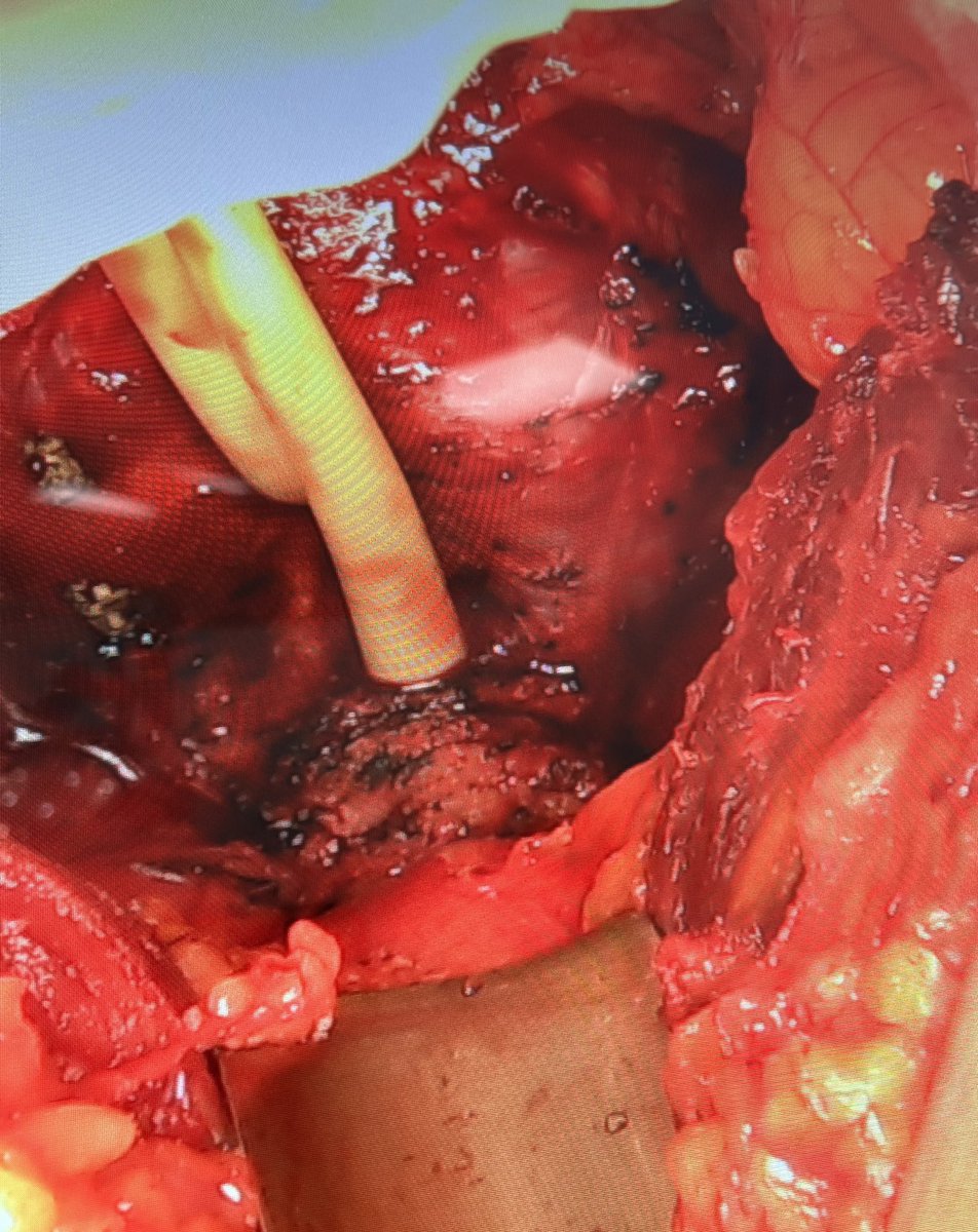 RomanCarvajal's tweet photo. Para los que dicen que no se ve nada en la prostatectomia radical abierta, ya les pusimos cámara 😄@ReinaAmigdala @marcial_orozco @felipeglezglez @so_uro @smumexico @Residentes_SMU https://t.co/Fb5K3zdClD