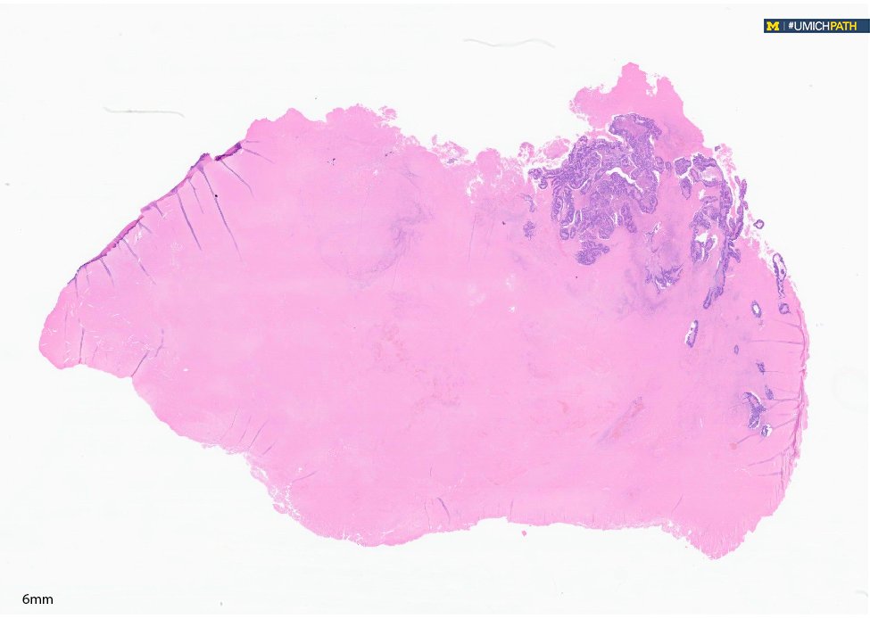 Michigan Pathology tweet media