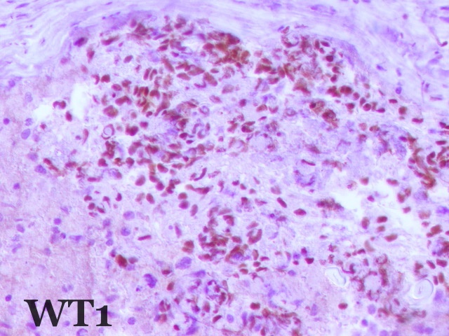 3/ #GIPath #BSTPath Puzzling case
M in 50's diagnosed at another lab as  gastric mod diff adenoca,went through chemo
Now 'epigastric node' ,SBRCT.nothing like adca
IHC is very focal 🧐 but still pos,can I make DSBRCT  with so focal pos? see the previous post
Your dx, what next? b