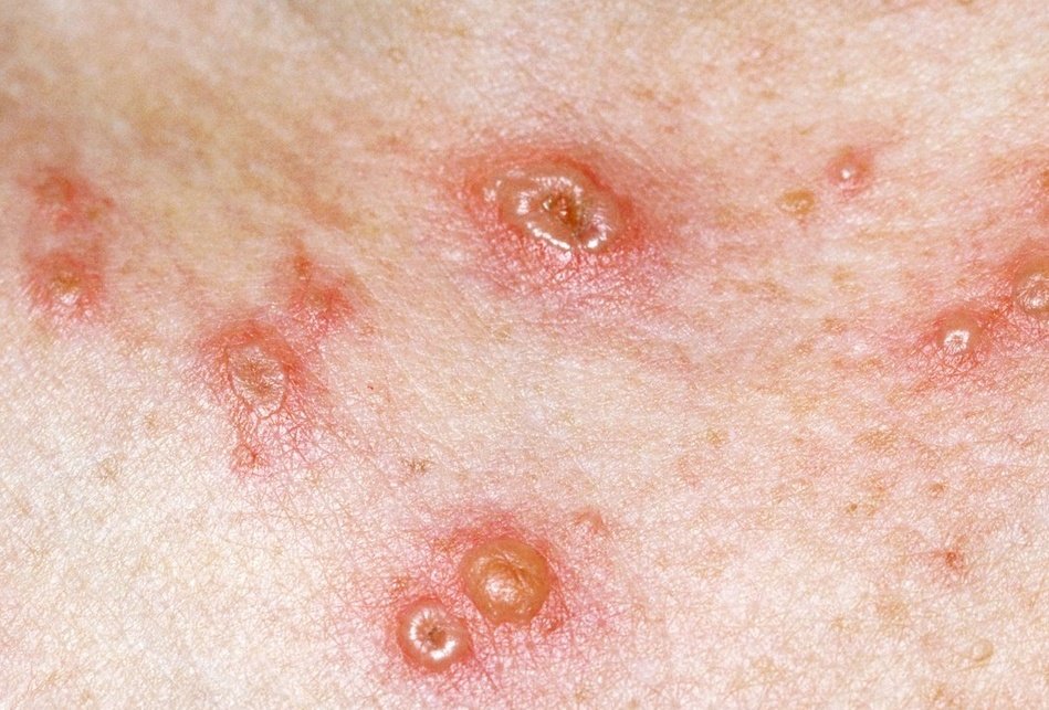 MicroLukas's tweet image. An idiots guide to chickenpox 🐔 + shingles + VZV. 

A short 🧵 containing essential bits of basic info to help you understand this highly contagious and extremely common infection/disease.
