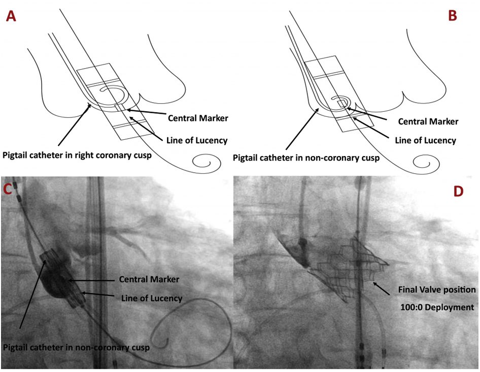 Because of the extremely high risk for pacemaker implantation we chose a balloon expandable valve. We aimed for a high implantation by using the radiolucent line as a guide as described by Ramanathan et al. doi.org/10.1080/247487…