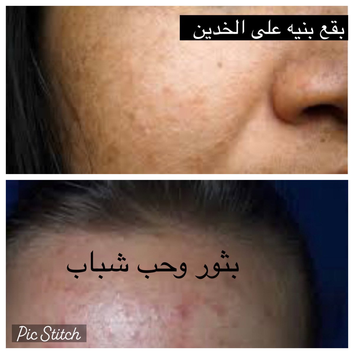 Dr_mahaalnemer's tweet photo. تغيرات طبيعية للبشرة في الحمل
 
▪️بقع بنية على الخدين والانف
▪️غمق الرقبه والابط 
▪️خط بني طولي غامق من البطن إلى الاسفل
▪️توسع الاوردة والدوالي 
▪️ترقق الجلد وحدوث علامات التمدد 
▪️زيادة شعر الوجه أو ظهور بثور

♦️السبب: 
هرمونات الحمل و زيادة هرمون الميلانين تحدث تصبغات عامه في الحمل
هذه التغيرات بعضها مؤقته وتزول بعد الولادة

♦️العلاج في الحمل:
استخدام كريمات عنايه وترطيب 
استخدام واقي الشمس وسكنيورين