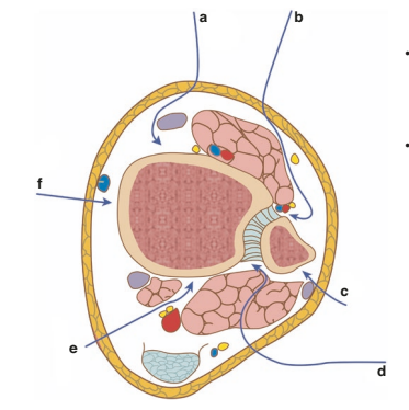 traumacito's tweet photo. #Abordajes quirúrgicos para reducción abierta y fijación de fracturas de pilón.
(A) Abordaje anteromedial
(B) Anterolateral
(C) Abordaje posterolateral del peroné
(D) Tibial posterolateral
(E) Abordaje posteromedial
(F) Abordaje medial https://t.co/cSboDpH2xf