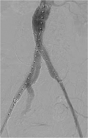 DrWheatley's tweet photo. Innovative technique for deployment of Iliac Branch Endograft in patient with challenge anatomy

https://t.co/kcSVifMr3Z https://t.co/AziOvLNrxQ