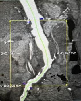 DrWheatley's tweet photo. Innovative technique for deployment of Iliac Branch Endograft in patient with challenge anatomy

https://t.co/kcSVifMr3Z https://t.co/AziOvLNrxQ