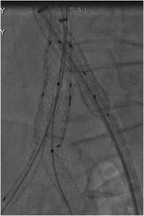 DrWheatley's tweet photo. Innovative technique for deployment of Iliac Branch Endograft in patient with challenge anatomy

https://t.co/kcSVifMr3Z https://t.co/AziOvLNrxQ
