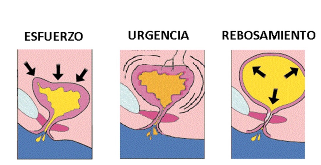 drapeggipinango's tweet photo. 50% de las mujeres presenta algún grado de incontinencia urinaria. Mayor riesgo si hay  multiples partos, obesidad, estreñimiento, sequedad. Afecta calidad de vida, sexualidad y riesgo de infecciones urinarias. Recomendaciones: ejercicios  Kegel, evita sobrepeso, fumar, alcohol https://t.co/XVgvoSGc55