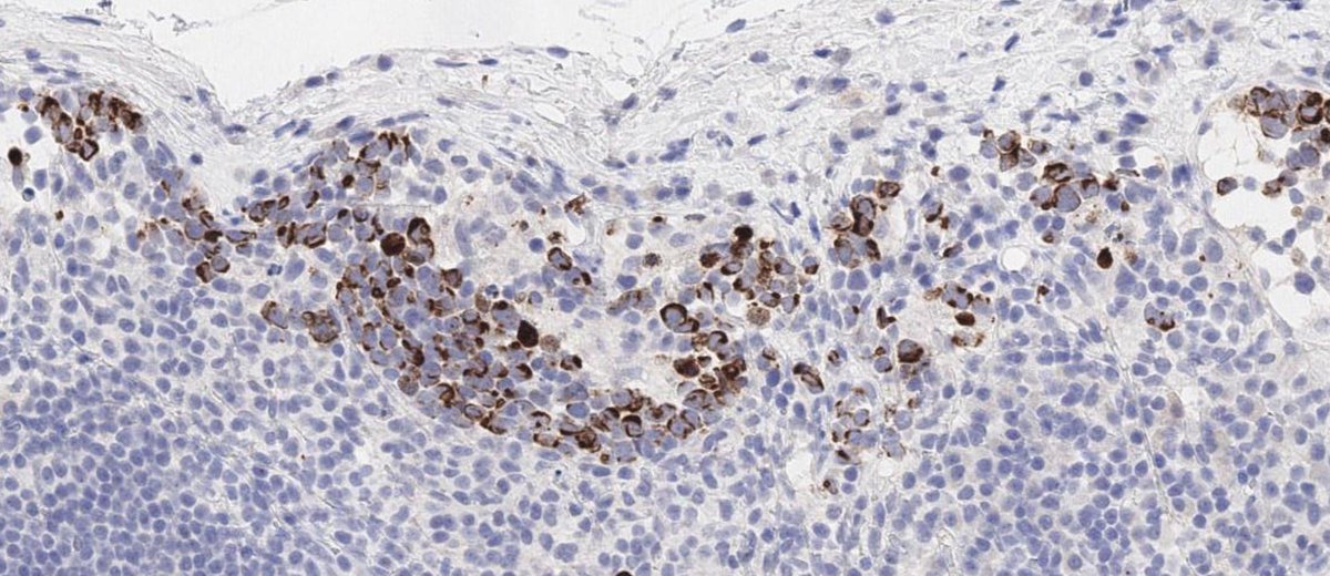 Merkel cell carcinoma metastasis in the lymph node!!
Look at this dot-like patterns 😯
#dermpath #PathTwitter #dermtwitter #unim