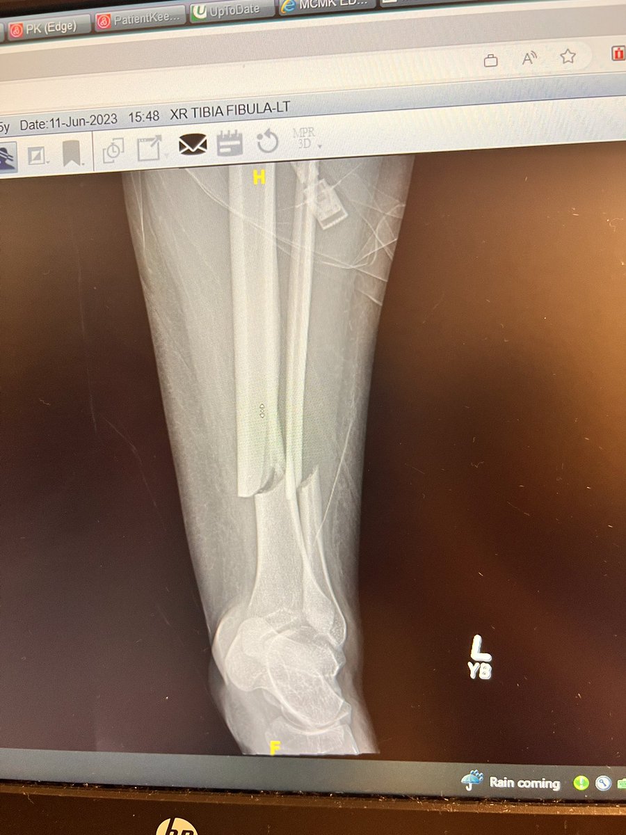 olivia_gruver's tweet image. Thank you to my family, friends, and all my 🥎 teammates and coaches for your🙏🏼 and just being by my side during this difficult time❤️‍🩹 #cannotcatchabreak #ohwait #trauma #softballinjury #roadtorecovery #bionicwoman