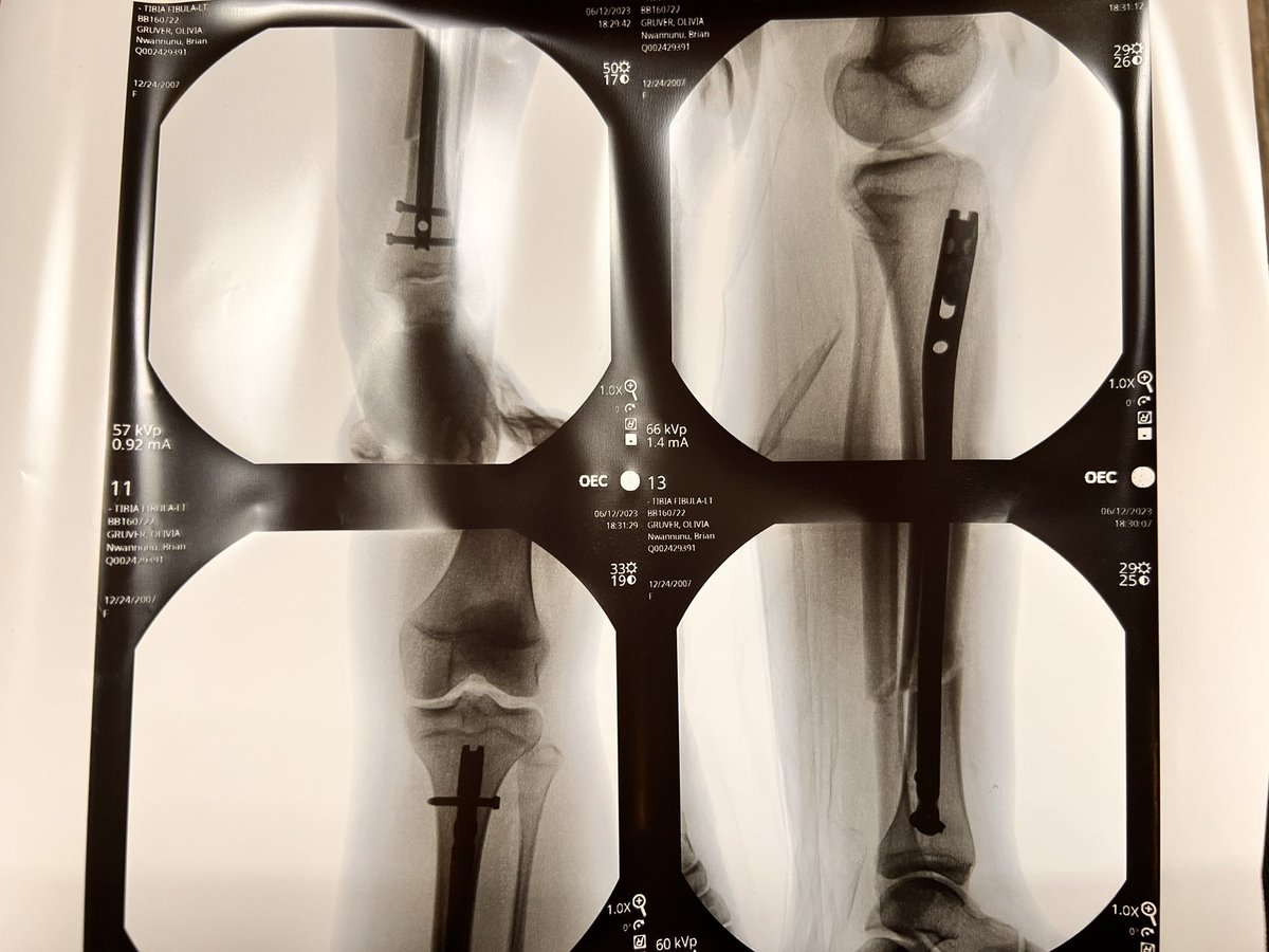 olivia_gruver's tweet image. Thank you to my family, friends, and all my 🥎 teammates and coaches for your🙏🏼 and just being by my side during this difficult time❤️‍🩹 #cannotcatchabreak #ohwait #trauma #softballinjury #roadtorecovery #bionicwoman