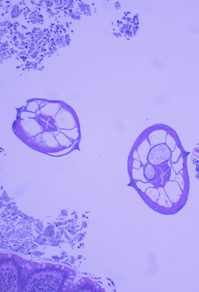 There is someone living in the appendix. 🏠🏠🏠

Enterobius vermicularis 🪱🪱🪱

Do you believe it can cause appendicitis❓❓❓

#MedTwitter #pathology #patología #patologia #PathTwitter #infectious 
#med #medicine #gipath