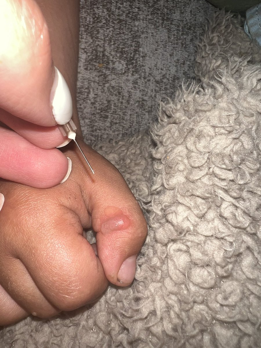 paryaneh's tweet photo. Finally lanced it! Have had this blister on my mind all day! Been waiting for my son to sleep so I could lance it as they aren’t self limiting blisters #epidermolysisbullosa #EBwarrior https://t.co/J7zietVyxx