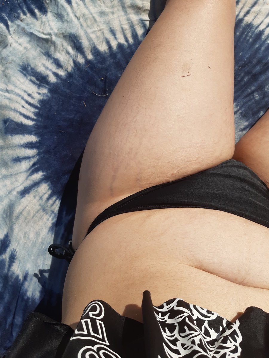 Was showing off my tiger stripes today again. Dont feel bad about your stretchmarks girls 😍 
I was kindof amazed how blueish they looked in the sun, the more visible ones I have rn I got last year when I dropped weight(from being sick)